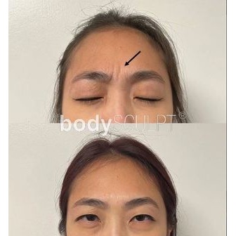 /botox_353036.jpg